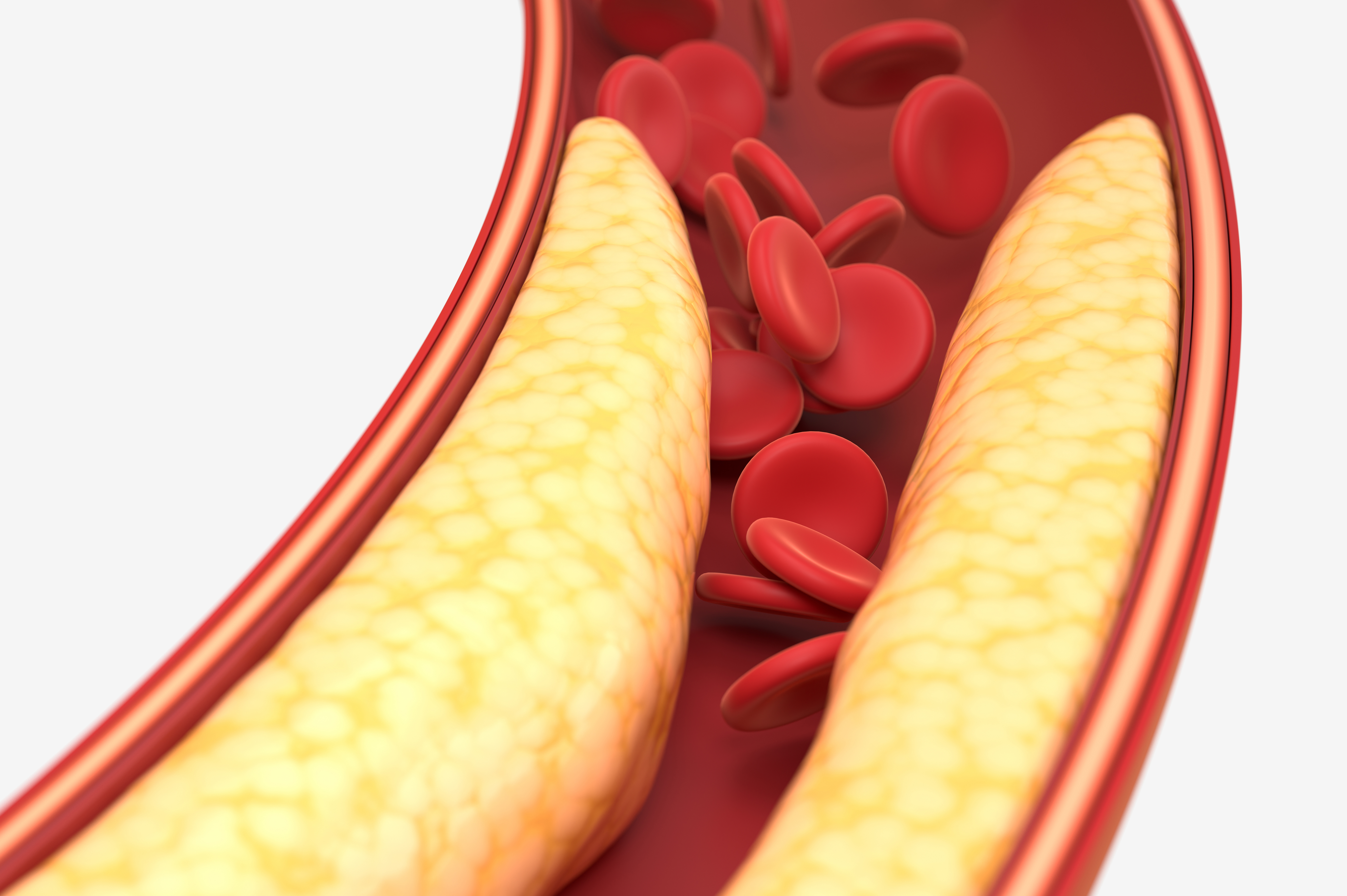 고혈압 설명 이미지